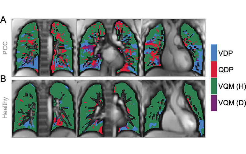 Pöhler Fig 5 RY Images show exemplary coronal sections of phase-resolved functional lung MRI defect maps in a pediatric participant with post-COVID-19 condition and cardiopulmonary symptoms and a health control.